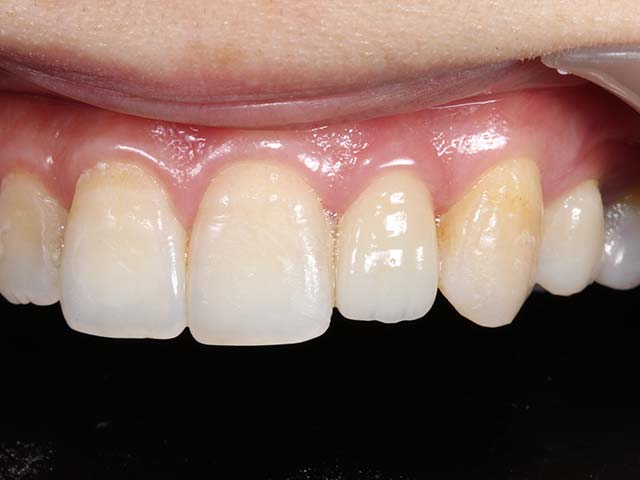 牙冠增長術(矯正拉出)