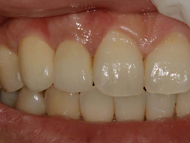 前牙排列不整齊