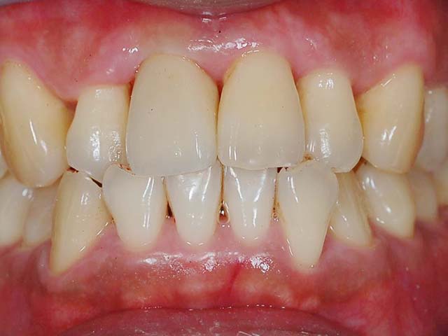 牙周病造成牙齦萎縮