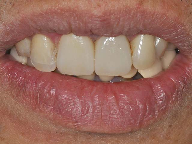 牙齦變色萎縮