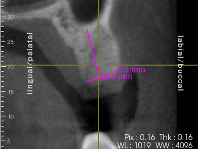 齒槽骨保存術+植牙