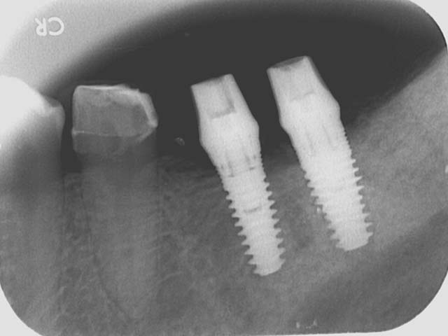 牙橋嚴重蛀牙，即拔即種，避免二次傷口