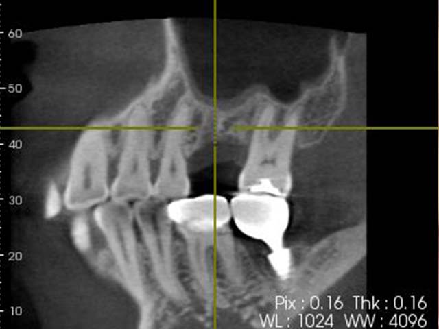 鼻竇增高術(垂直)+植牙
